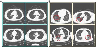 Contrastive learning with token projection for Omicron pneumonia identification from few-shot chest CT images